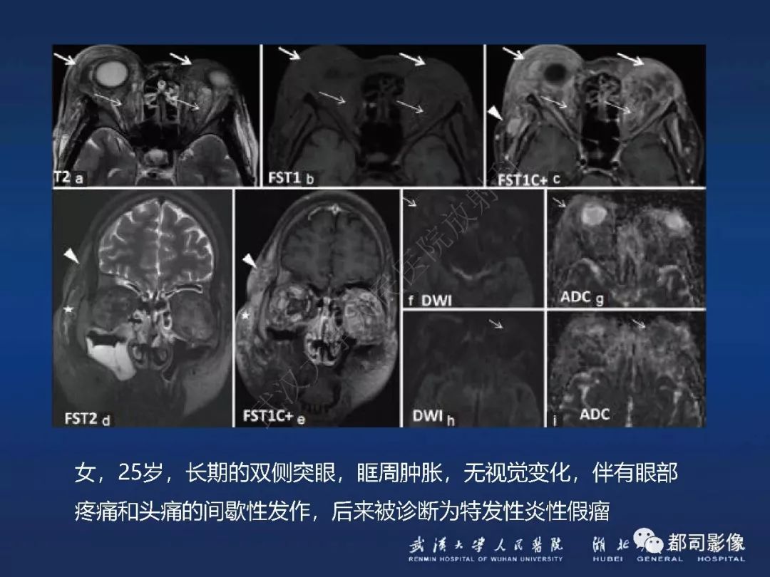 【PPT】眼眶黏膜相关淋巴组织淋巴瘤影像诊断