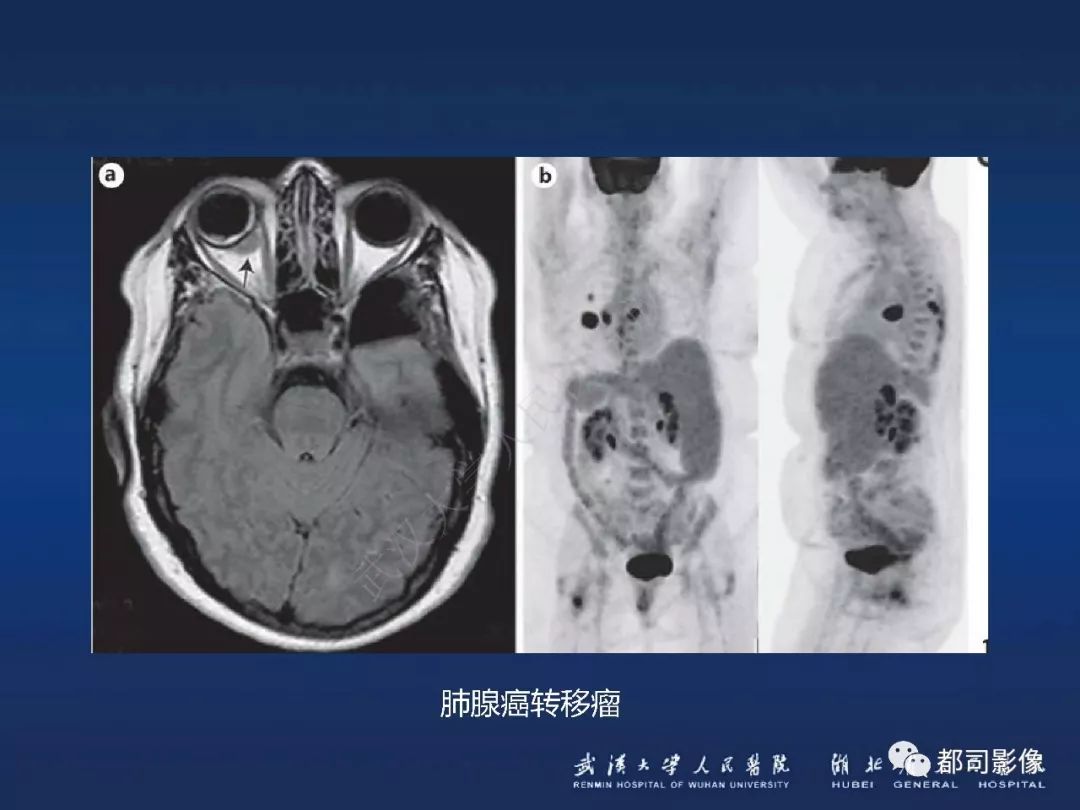 【PPT】眼眶黏膜相关淋巴组织淋巴瘤影像诊断