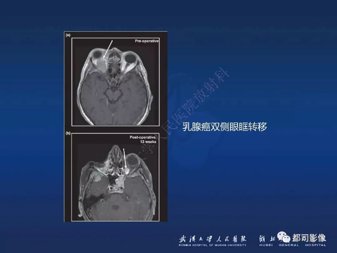 【PPT】眼眶黏膜相关淋巴组织淋巴瘤影像诊断