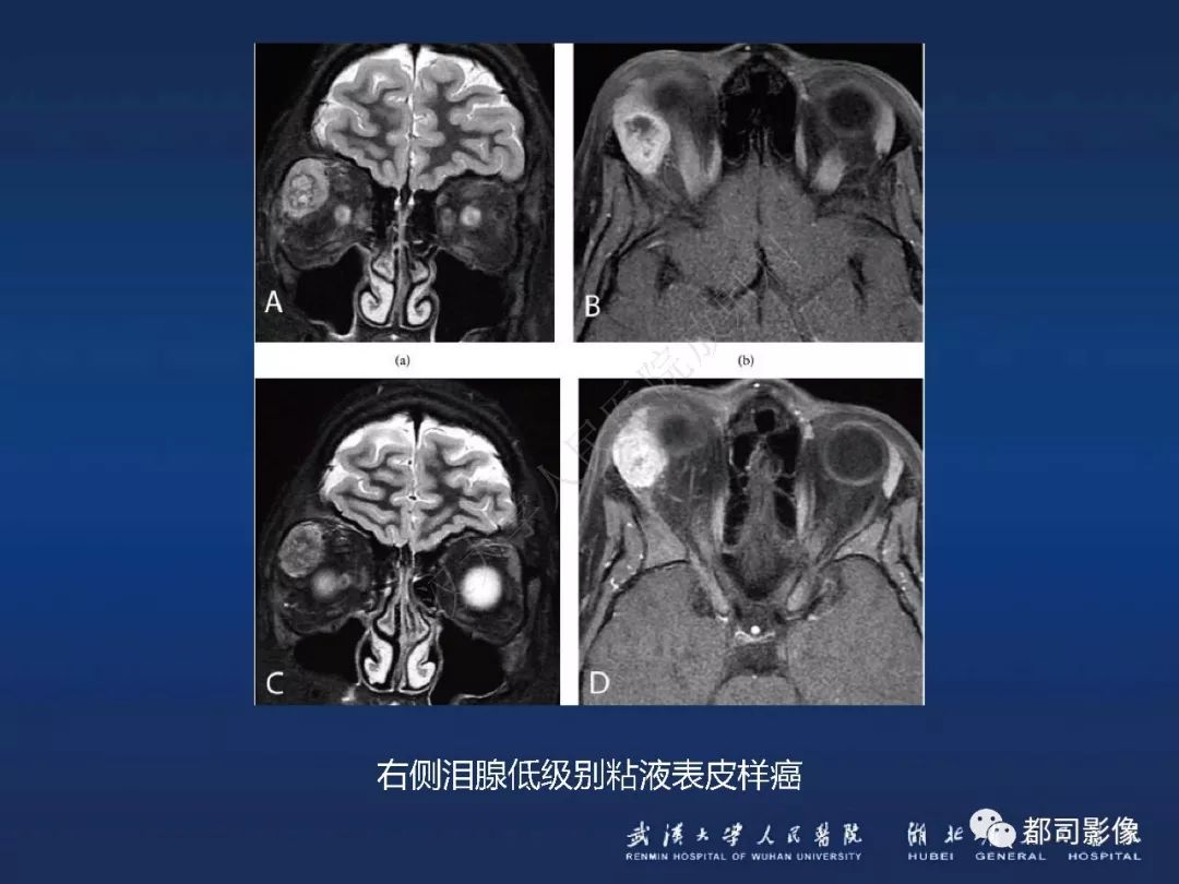 【PPT】眼眶黏膜相关淋巴组织淋巴瘤影像诊断