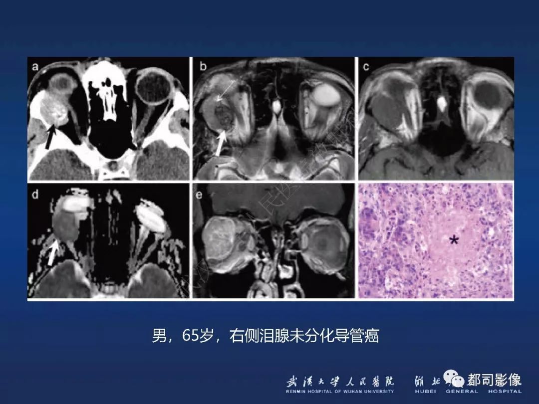【PPT】眼眶黏膜相关淋巴组织淋巴瘤影像诊断