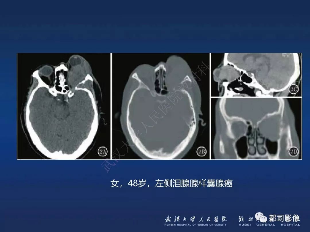 【PPT】眼眶黏膜相关淋巴组织淋巴瘤影像诊断
