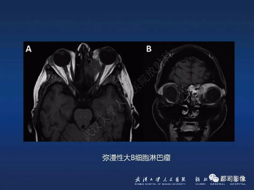 【PPT】眼眶黏膜相关淋巴组织淋巴瘤影像诊断