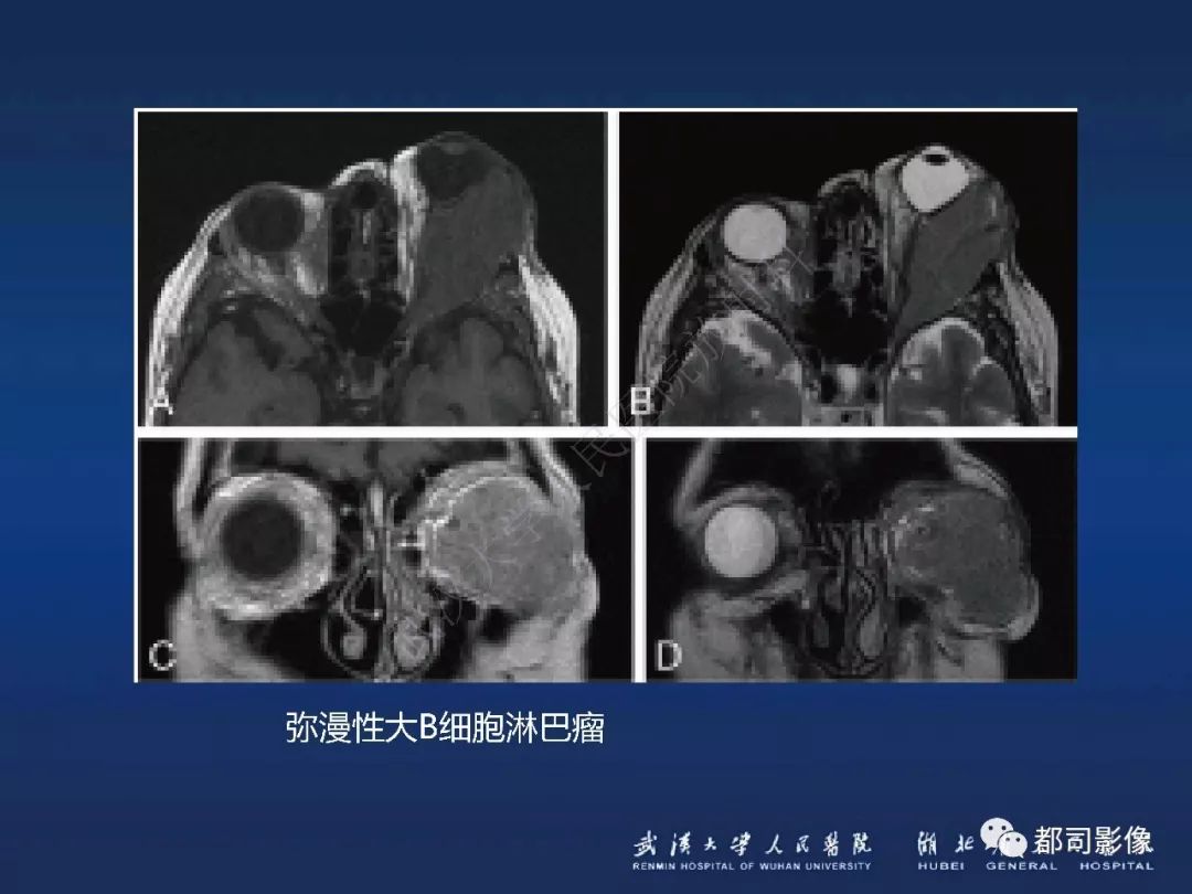 【PPT】眼眶黏膜相关淋巴组织淋巴瘤影像诊断
