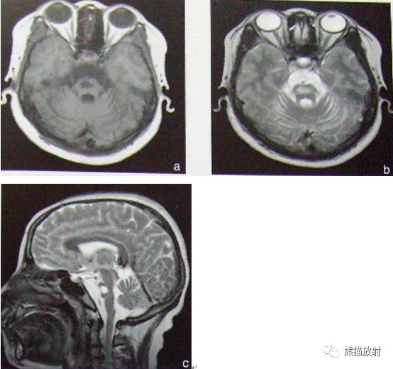 影像病理丨脑桥中央髓鞘溶解症+诊断/鉴别诊断 影像病理丨脑桥中央髓鞘溶解症+诊断/鉴别诊断