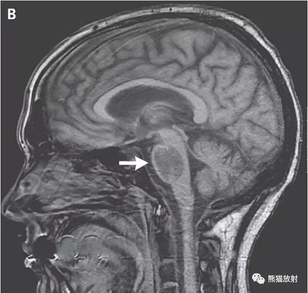 影像病理丨脑桥中央髓鞘溶解症+诊断/鉴别诊断 影像病理丨脑桥中央髓鞘溶解症+诊断/鉴别诊断