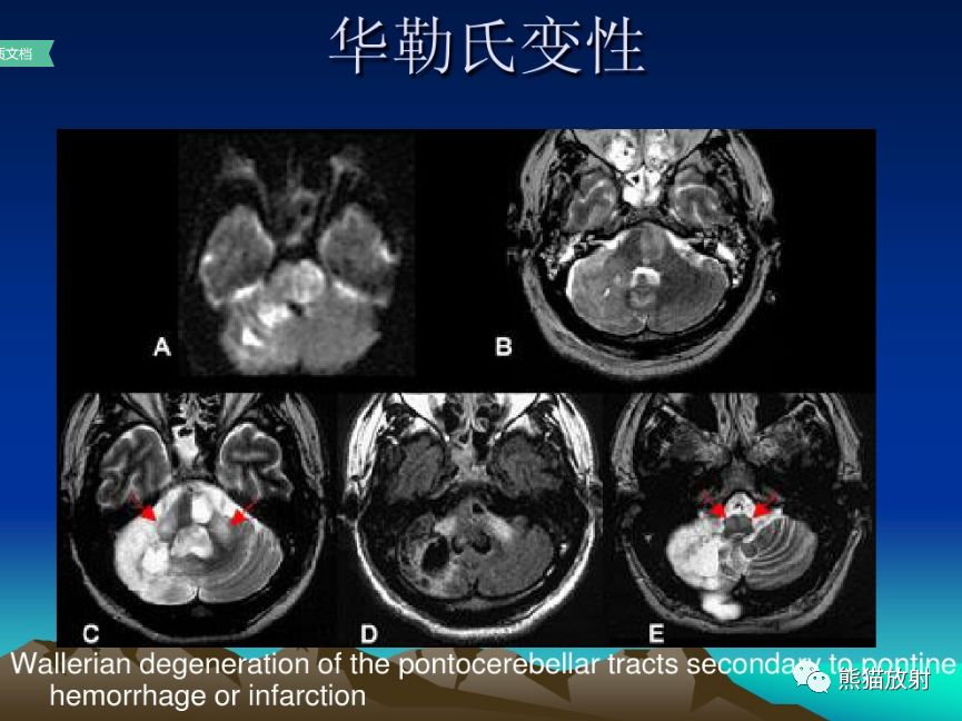 影像病理丨脑桥中央髓鞘溶解症+诊断/鉴别诊断 影像病理丨脑桥中央髓鞘溶解症+诊断/鉴别诊断