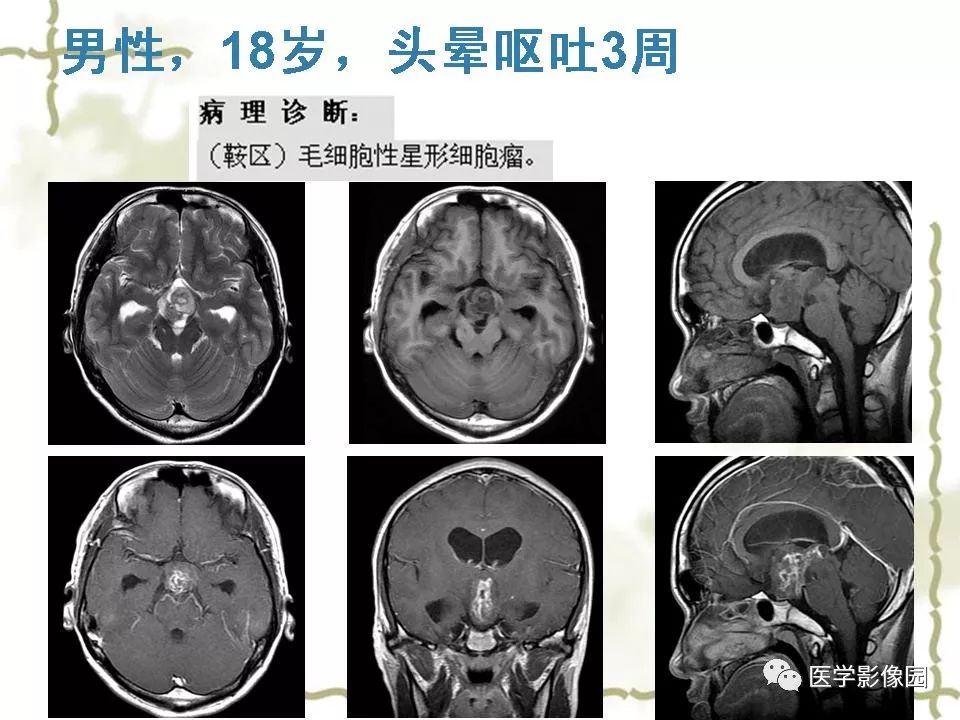 【PPT】鞍区毛细胞型星形细胞瘤的MRI诊断及鉴别诊断