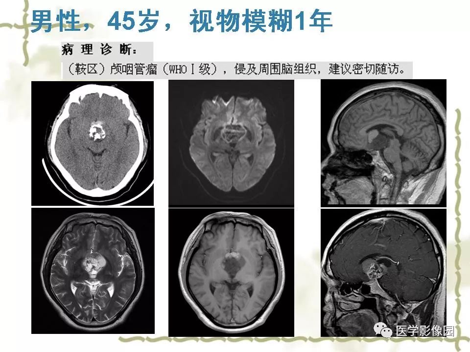 【PPT】鞍区毛细胞型星形细胞瘤的MRI诊断及鉴别诊断