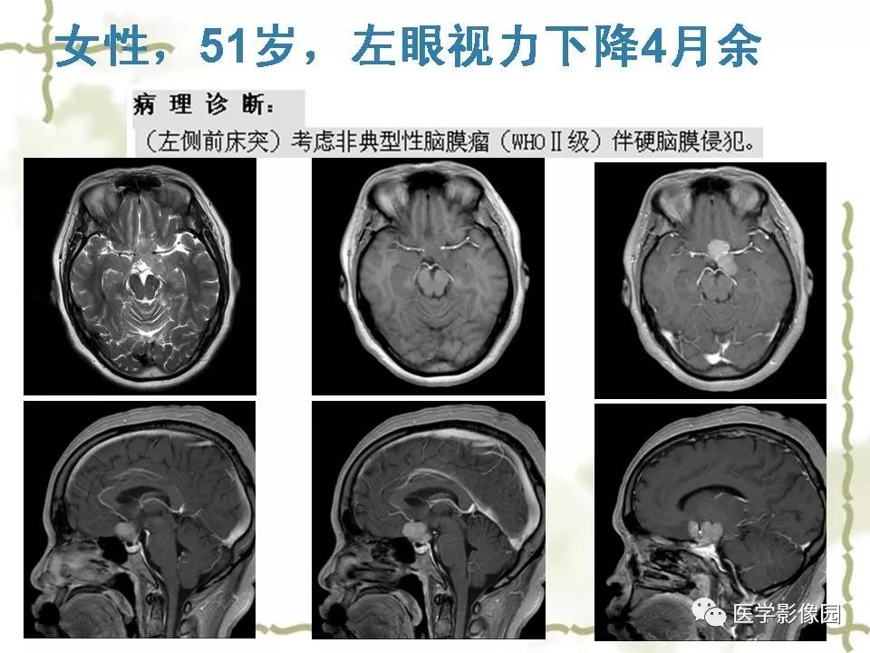 【PPT】鞍区毛细胞型星形细胞瘤的MRI诊断及鉴别诊断