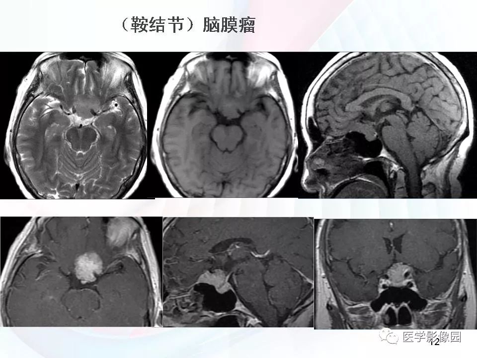 【PPT】鞍区毛细胞型星形细胞瘤的MRI诊断及鉴别诊断