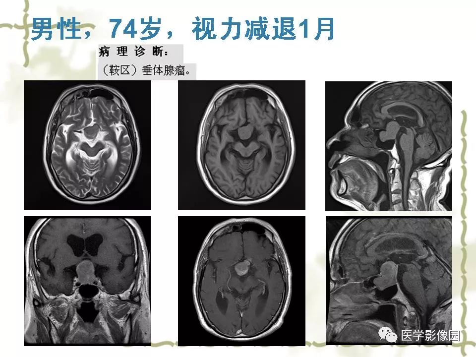 【PPT】鞍区毛细胞型星形细胞瘤的MRI诊断及鉴别诊断