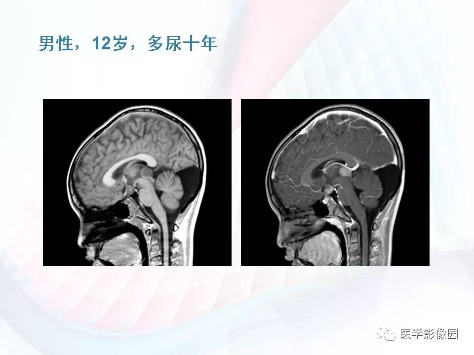 【PPT】鞍区毛细胞型星形细胞瘤的MRI诊断及鉴别诊断