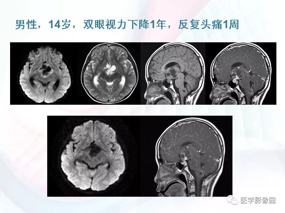 【PPT】鞍区毛细胞型星形细胞瘤的MRI诊断及鉴别诊断