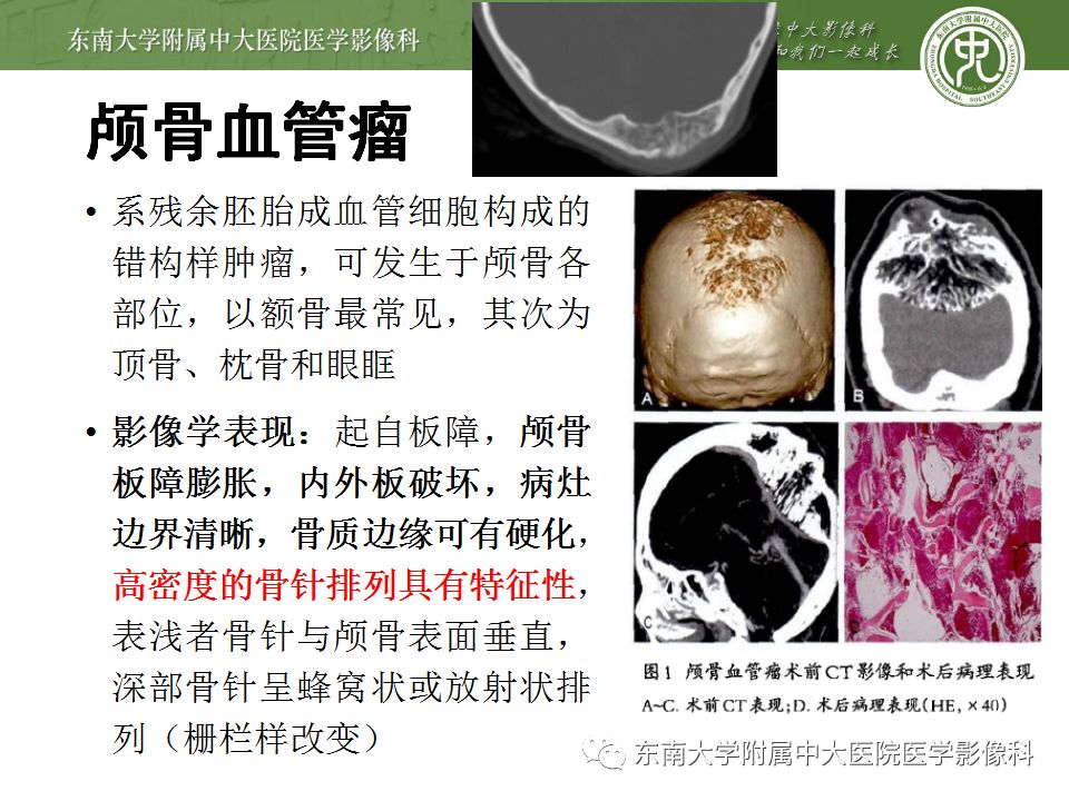 【病例】颅骨嗜酸性肉芽肿1例CT及MR