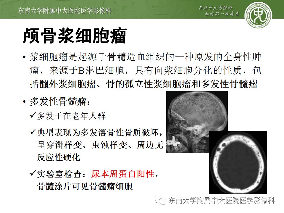 【病例】颅骨嗜酸性肉芽肿1例CT及MR