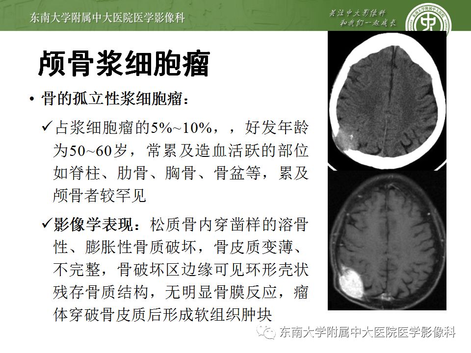 【病例】颅骨嗜酸性肉芽肿1例CT及MR