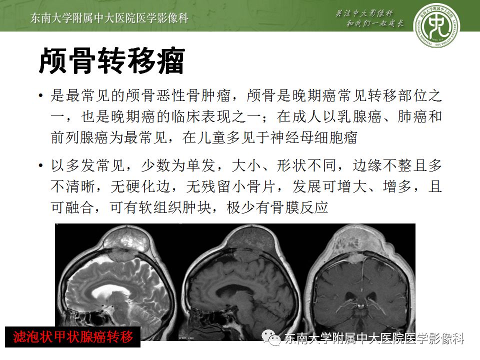 【病例】颅骨嗜酸性肉芽肿1例CT及MR