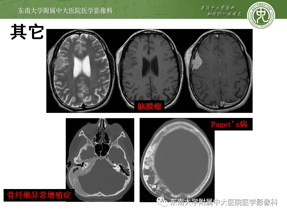 【病例】颅骨嗜酸性肉芽肿1例CT及MR