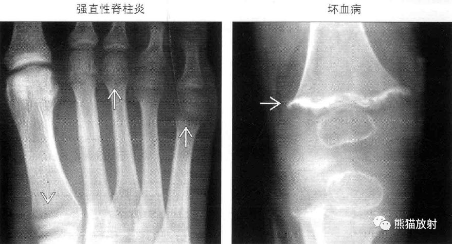 儿童长骨及干骺端—— 儿童长骨及干骺端——