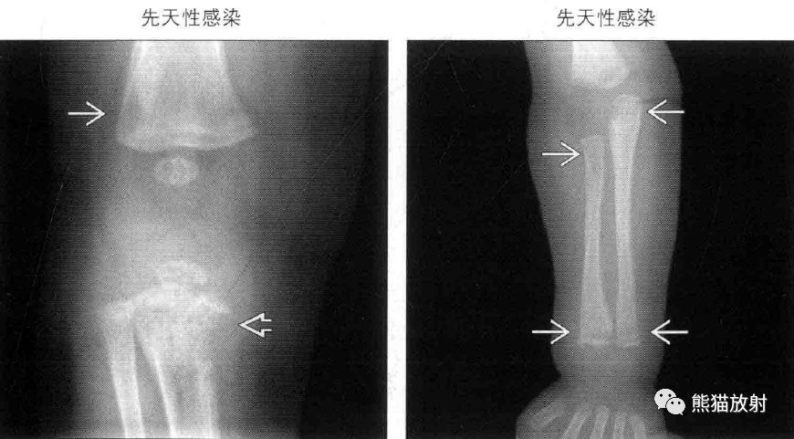 儿童长骨及干骺端—— 儿童长骨及干骺端——