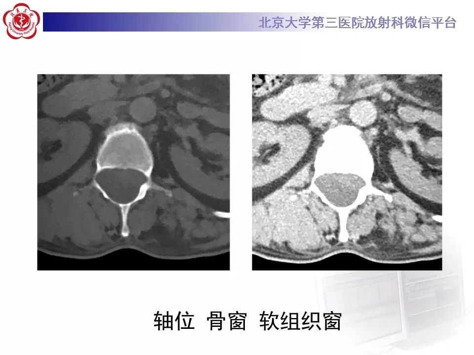 【病例】椎管内脊膜囊肿1例CT及MR