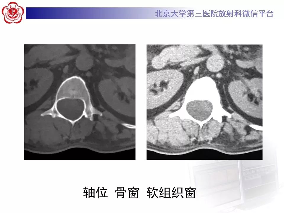 【病例】椎管内脊膜囊肿1例CT及MR