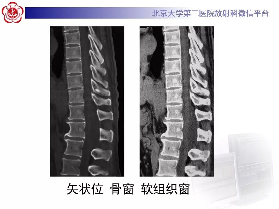 【病例】椎管内脊膜囊肿1例CT及MR