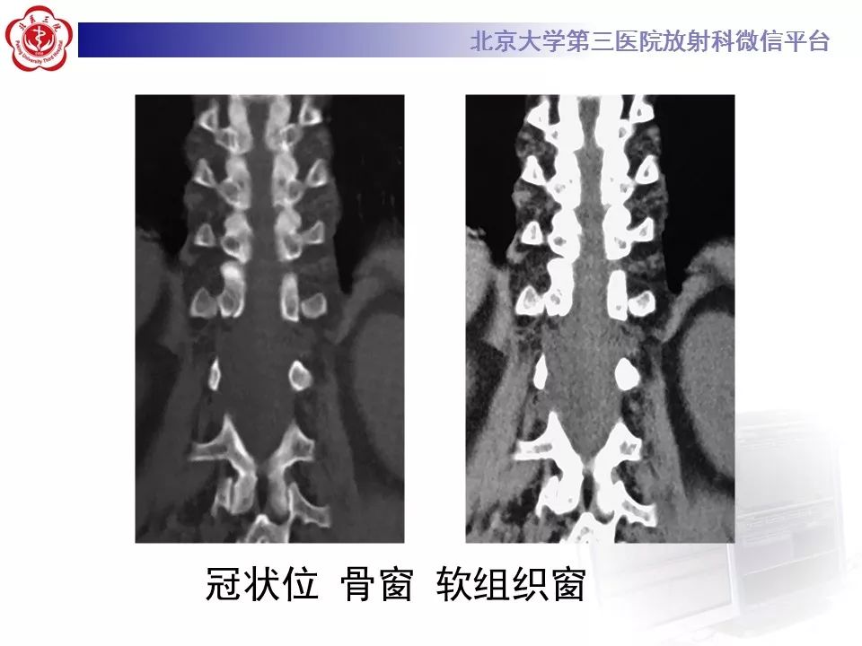 【病例】椎管内脊膜囊肿1例CT及MR