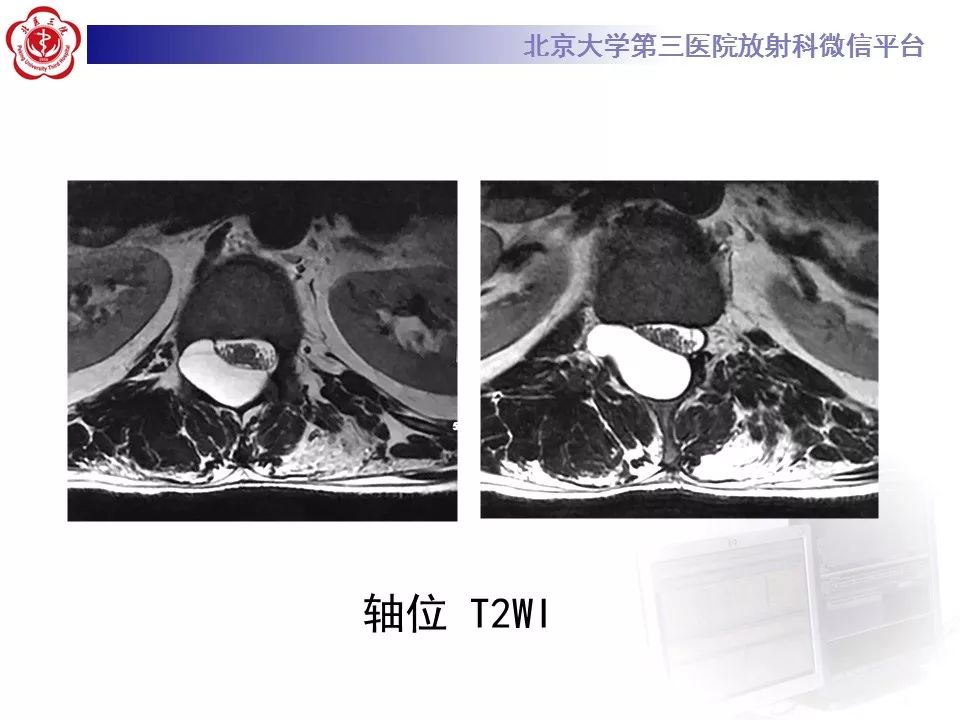 【病例】椎管内脊膜囊肿1例CT及MR