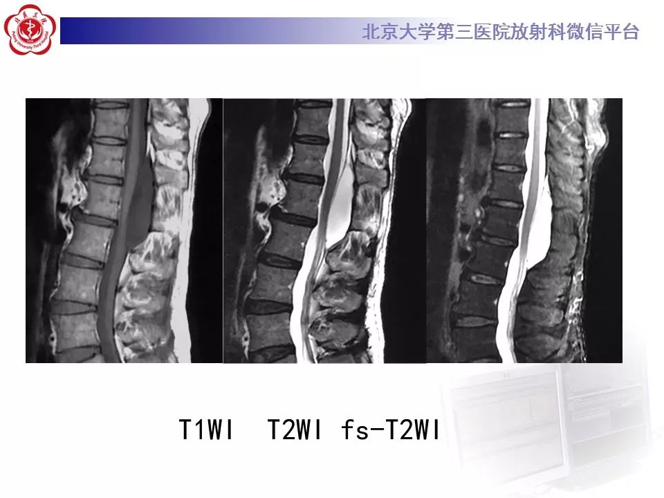【病例】椎管内脊膜囊肿1例CT及MR