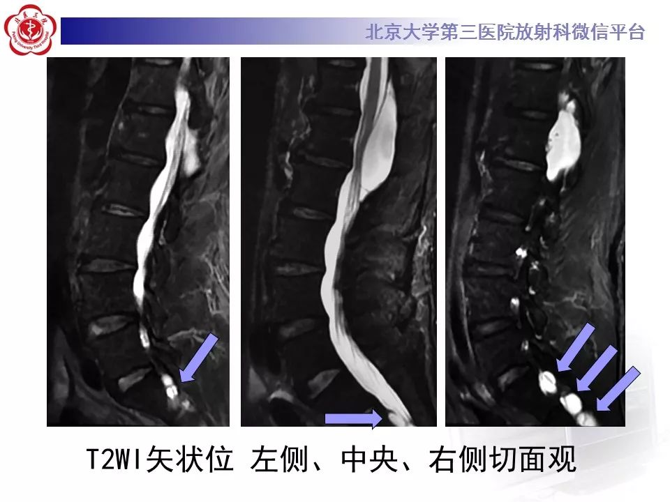【病例】椎管内脊膜囊肿1例CT及MR