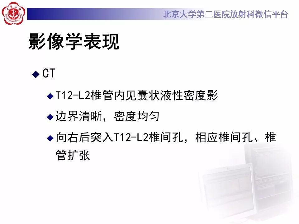 【病例】椎管内脊膜囊肿1例CT及MR
