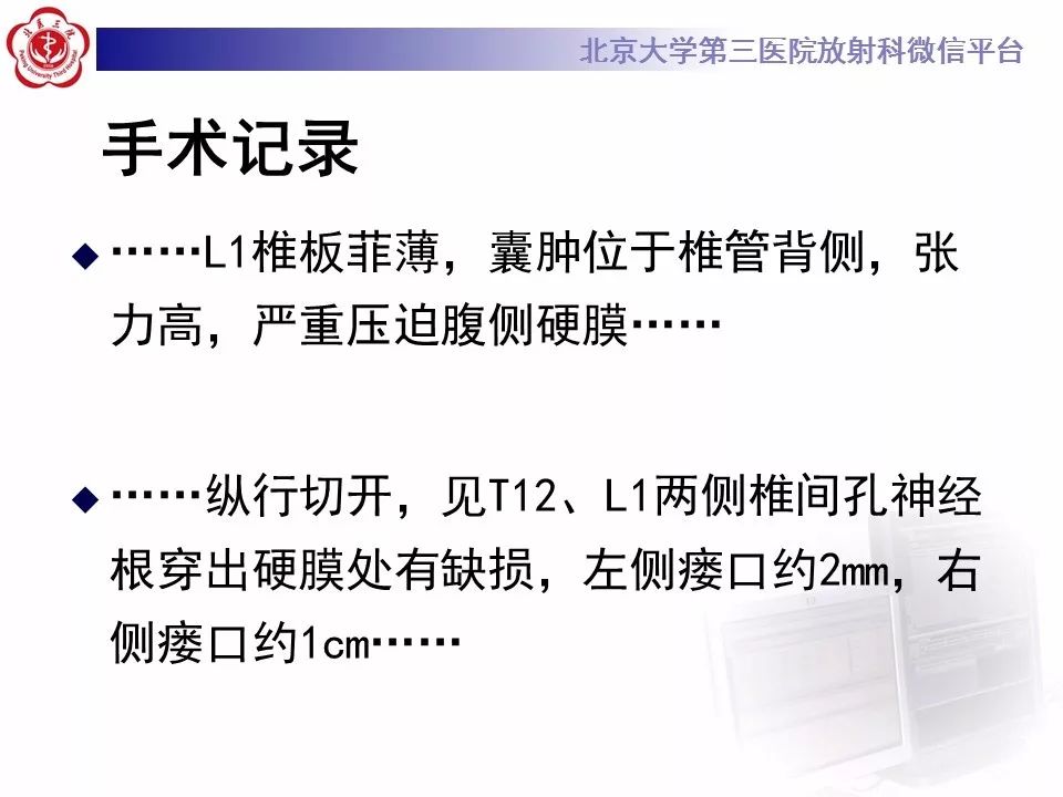 【病例】椎管内脊膜囊肿1例CT及MR
