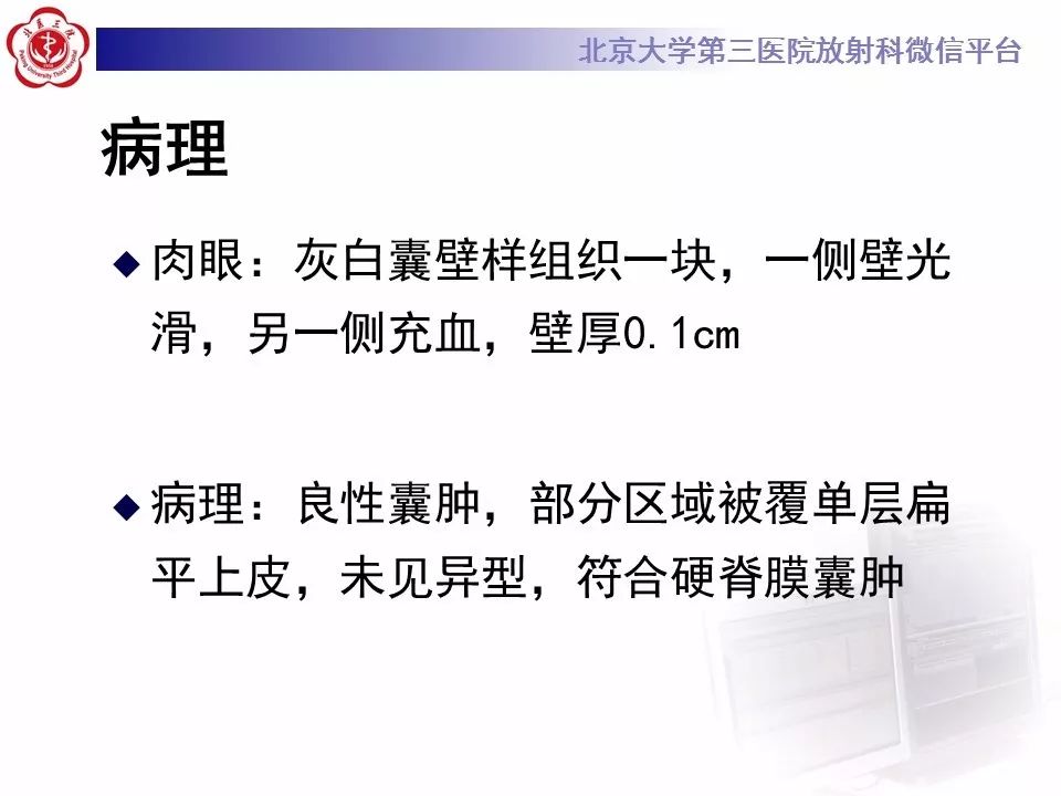 【病例】椎管内脊膜囊肿1例CT及MR