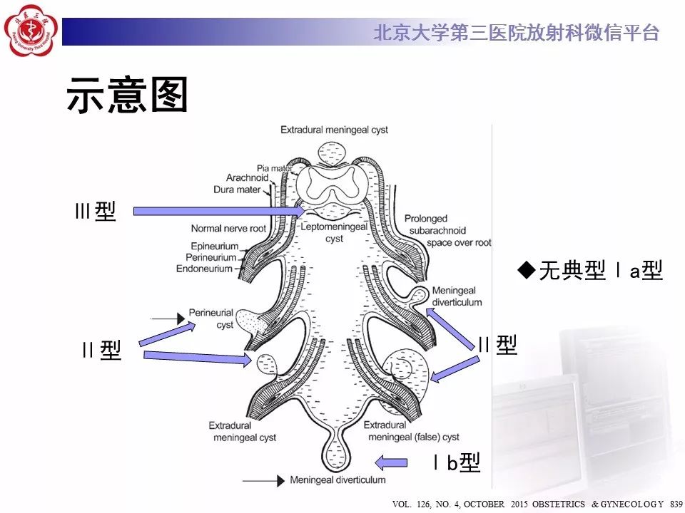 【病例】椎管内脊膜囊肿1例CT及MR