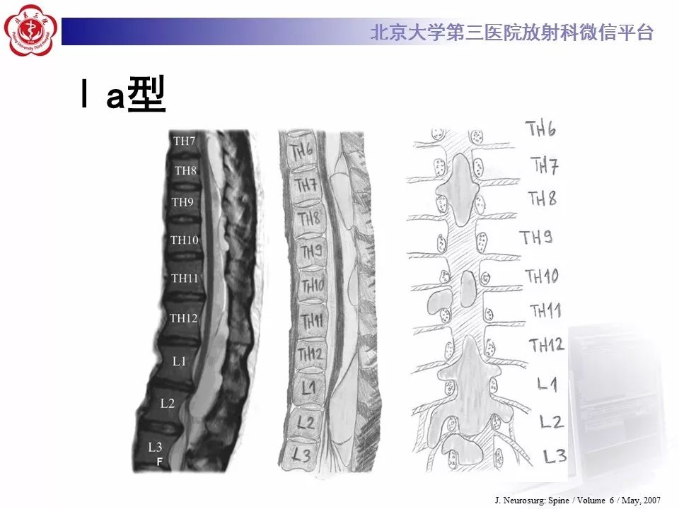 【病例】椎管内脊膜囊肿1例CT及MR