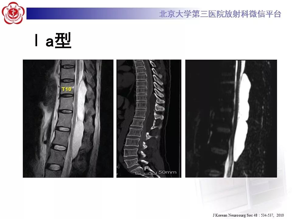 【病例】椎管内脊膜囊肿1例CT及MR