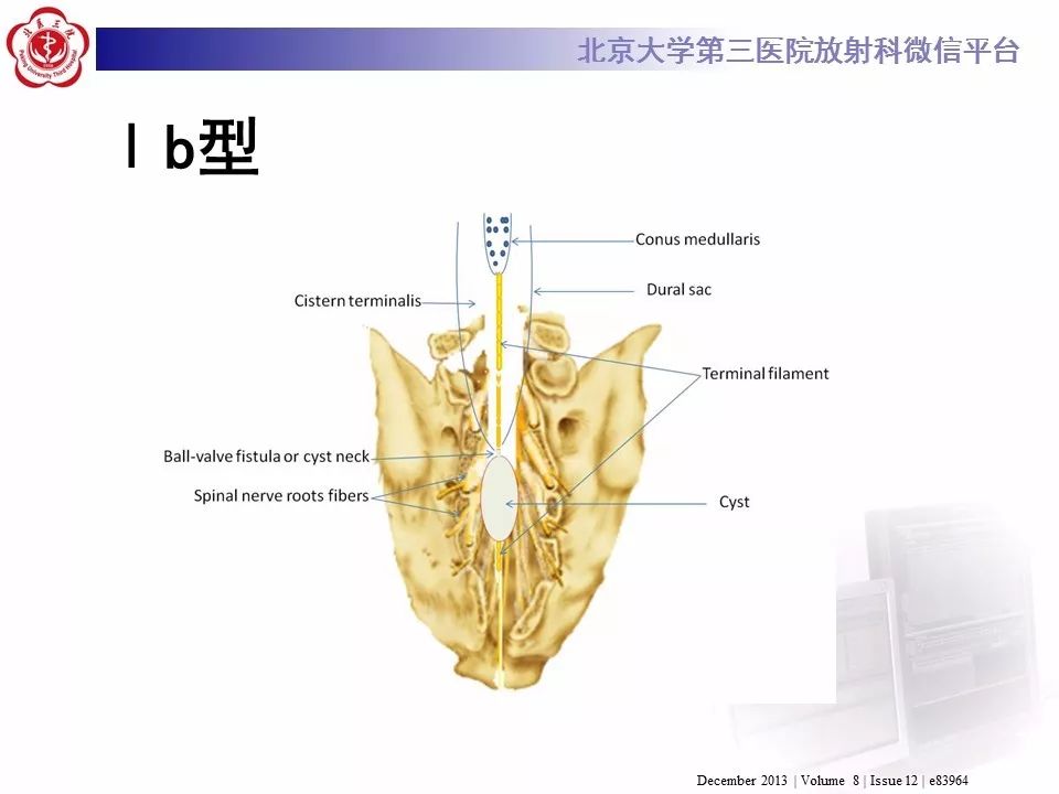 【病例】椎管内脊膜囊肿1例CT及MR