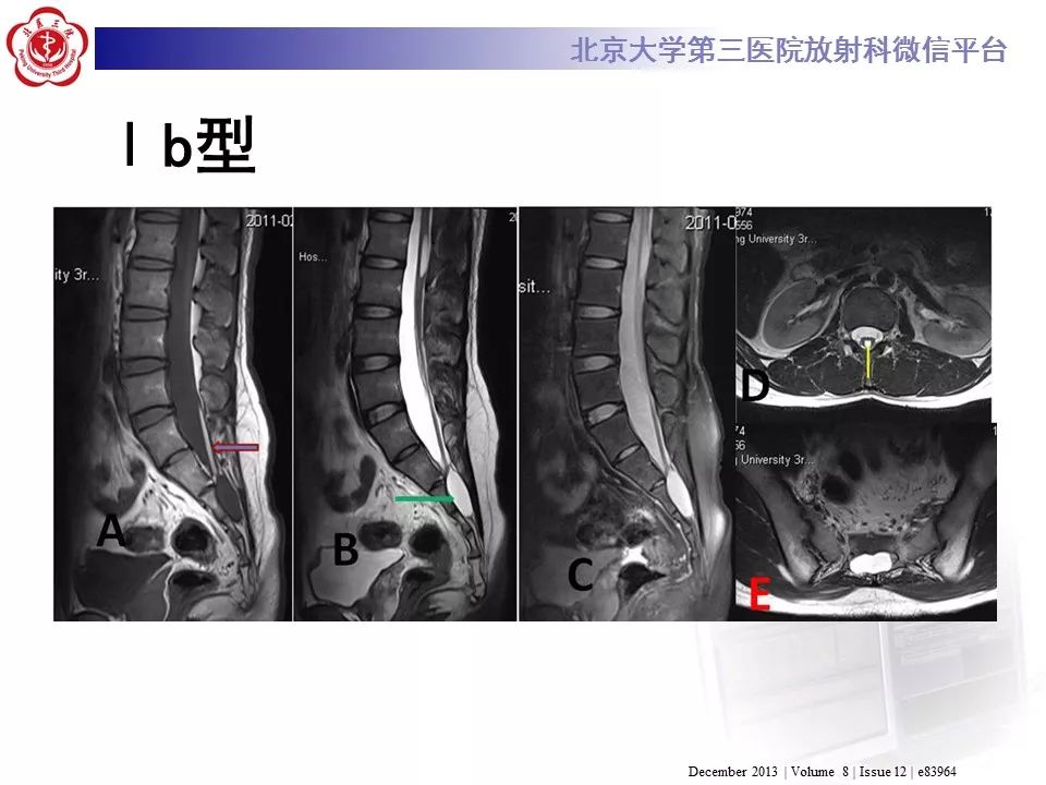 【病例】椎管内脊膜囊肿1例CT及MR