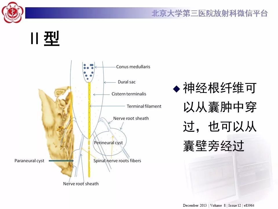 【病例】椎管内脊膜囊肿1例CT及MR
