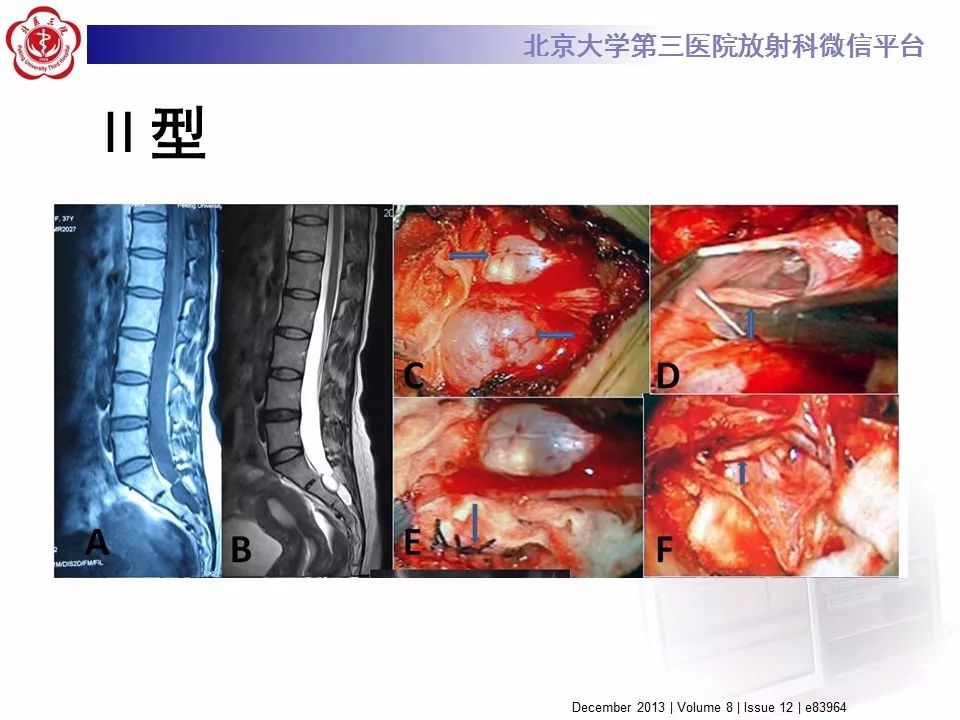 【病例】椎管内脊膜囊肿1例CT及MR