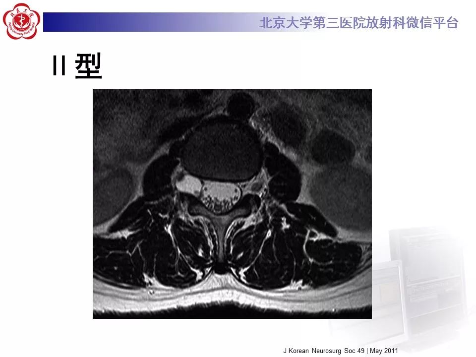 【病例】椎管内脊膜囊肿1例CT及MR