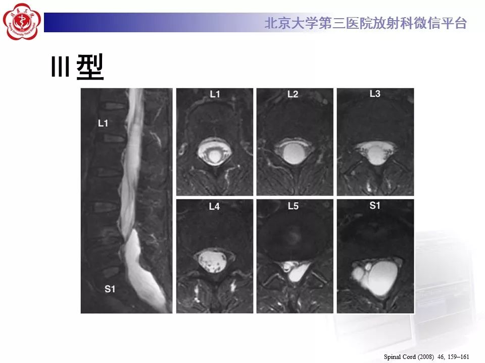 【病例】椎管内脊膜囊肿1例CT及MR