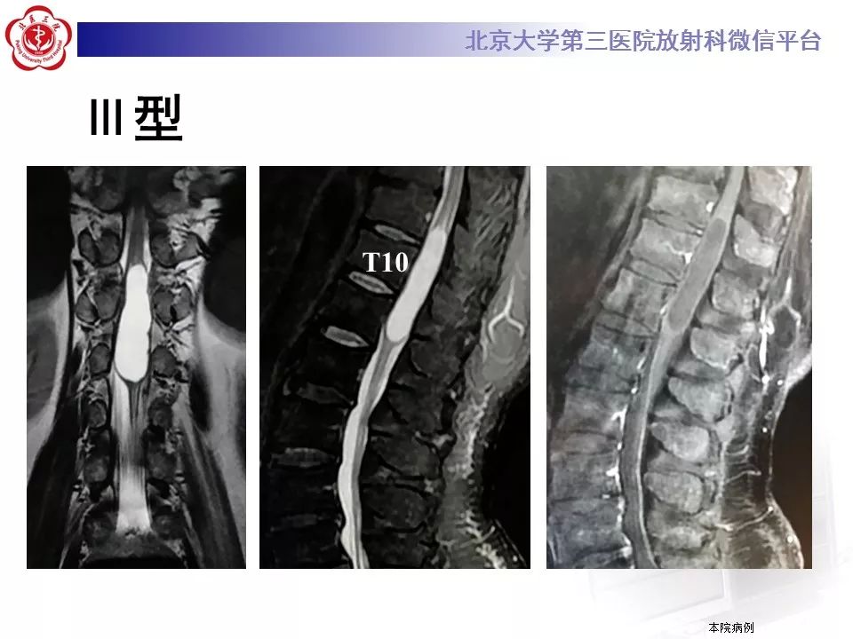 【病例】椎管内脊膜囊肿1例CT及MR