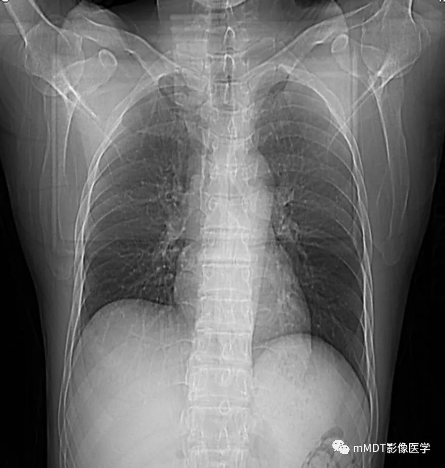【病例】髂骨骨肉瘤1例CT及MR影像诊断分析 【病例】髂骨骨肉瘤1例CT及MR影像诊断分析