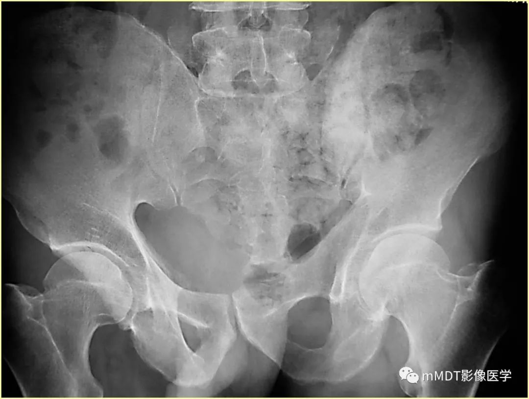 【病例】髂骨骨肉瘤1例CT及MR影像诊断分析 【病例】髂骨骨肉瘤1例CT及MR影像诊断分析