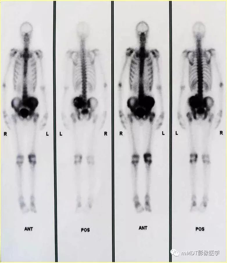 【病例】髂骨骨肉瘤1例CT及MR影像诊断分析 【病例】髂骨骨肉瘤1例CT及MR影像诊断分析