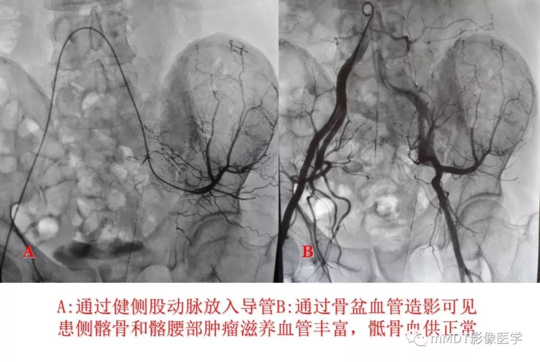 【病例】髂骨骨肉瘤1例CT及MR影像诊断分析 【病例】髂骨骨肉瘤1例CT及MR影像诊断分析