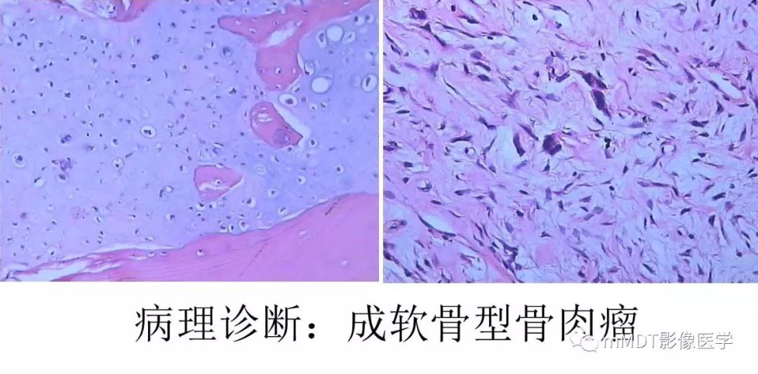 【病例】髂骨骨肉瘤1例CT及MR影像诊断分析 【病例】髂骨骨肉瘤1例CT及MR影像诊断分析